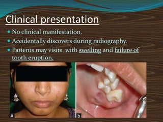 Clinical presentation
 No clinical manifestation.
 Accidentally discovers during radiography.
 Patients may visits with swelling and failure of
tooth eruption.
 