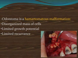 -Odontoma is a hamartomatous malformation:
•Disorganized mass of cells
•Limited growth potential
•Limited recurrance
 
