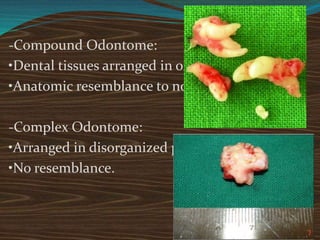 -Compound Odontome:
•Dental tissues arranged in orderly pattern.
•Anatomic resemblance to normal teeth.
-Complex Odontome:
•Arranged in disorganized pattern.
•No resemblance.
 