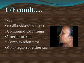-Site
•Maxilla >Mandible (3:1)
1.Compound Odontoma
•Anterior maxilla
2.Complex odontoma
•Molar region of either jaw.
 