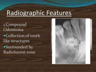 Radiographic Features
1.Compound
Odontoma
Collection of tooth
like structures
Surrounded by
Radiolucent zone
 