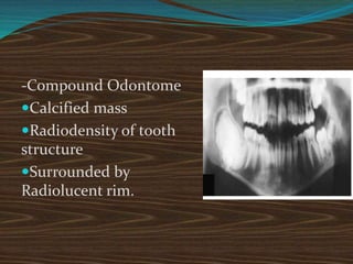 -Compound Odontome
Calcified mass
Radiodensity of tooth
structure
Surrounded by
Radiolucent rim.
 
