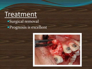 Treatment
Surgical removal
Prognosis is excellent
 