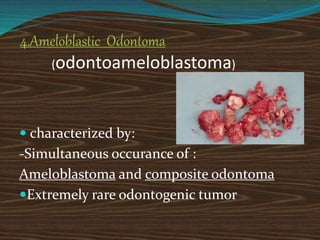 4.Ameloblastic Odontoma
(odontoameloblastoma)
 characterized by:
-Simultaneous occurance of :
Ameloblastoma and composite odontoma
Extremely rare odontogenic tumor
 