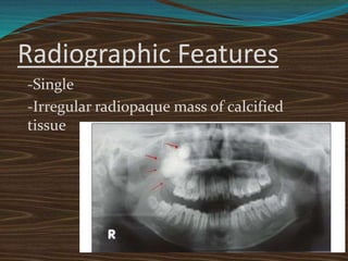 Radiographic Features
-Single
-Irregular radiopaque mass of calcified
tissue
 
