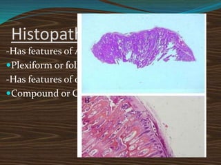 Histopathology
-Has features of Ameloblastoma
Plexiform or follicular pattern.
-Has features of odontoma
Compound or Complex
 