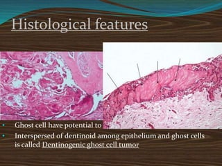 Histological features
• Fibrous capsule is lined by 4-10 cell thickness
• Basal cells are cuboidal or columnar with polarized nuclei
• Within epithelial component presence of
characterstic “ Ghost cells” undergoing keratinization
• Ghost cell are eosinophilic epithelial cells that lacks nuclei
with preservation of outline
• Ghost cell have potential to calcify
• Interspersed of dentinoid among epithelium and ghost cells
is called Dentinogenic ghost cell tumor
 
