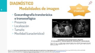 DIAGNÓSTICO
Modalidades de imagen
▹ Ecocardiografía transtorácica
o transesofágica
▹ Presencia
▹ Localización
▹ Tamaño
▹ Movilidad (característico)
11
GOLD
STANDARD
Rahmanian P et al. Cardiac myxoma: preoperative diagnosis using a multimodal imagen approach and surgical outcome in a large contemporary series. Interactive Cardiovascular and Thoracic Surgery 6 (2007) 479-483. doi: 10.1510/icvts.2007.154096.
Thyagarajan et al. Extracardiac manifestations of atrial myxomas. Journal of the Saudi Heart Association. Volume 29. Issue 1. January 2017. Pages 37-43. https://doi.org/10.1016/j.jsha.2016.07.003
Hoffmeier A, Sindermann JR, Scheld HH, Martens S: Cardiac tumors-diagnosis and surgical treatment. Dtsch Arztebl Int 2014; 11(12): 205-11. DOI: 10.3238/arztebl.2014.0205.
Ecocardiograma: mixoma atrial (a) izquierdo y (b) derecho.
LA = atrio izquierdo, LV = ventrículo izquierdo. RA = atrio derecho. RV = ventrículo derecho.
Imagen de Rahmanian P et al. Cardiac myxoma: preoperative diagnosis using a multimodal imagen approach and surgical
outcome in a large contemporary series. Interactive Cardiovascular and Thoracic Surgery 6 (2007) 479-483. doi:
10.1510/icvts.2007.154096.
 