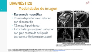 DIAGNÓSTICO
Modalidades de imagen
▹ Resonancia magnética
▹ T1: masa hipointensa en relación
con el miocardio
▹ T2: masa hiperintensa
▹ Estos hallazgos sugieren un tumor
con gran contenido de líquido
extracelular (tejido mixomatoso)
13
Rahmanian P et al. Cardiac myxoma: preoperative diagnosis using a multimodal imagen approach and surgical outcome in a large contemporary series. Interactive Cardiovascular and Thoracic Surgery 6 (2007) 479-483. doi: 10.1510/icvts.2007.154096.
Thyagarajan et al. Extracardiac manifestations of atrial myxomas. Journal of the Saudi Heart Association.Volume 29. Issue 1. January 2017. Pages 37-43. https://doi.org/10.1016/j.jsha.2016.07.003
Hoffmeier A, Sindermann JR, Scheld HH, Martens S: Cardiac tumors-diagnosis and surgical treatment. Dtsch Arztebl Int 2014; 11(12): 205-11. DOI: 10.3238/arztebl.2014.0205.
Mixoma atrial izquierdo visto por resonancia magnética
Imagen de Rahmanian P et al. Cardiac myxoma: preoperative diagnosis using a multimodal imagen approach and
surgical outcome in a large contemporary series. Interactive Cardiovascular and Thoracic Surgery 6 (2007) 479-
483. doi: 10.1510/icvts.2007.154096.
 
