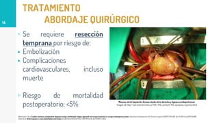 TRATAMIENTO
ABORDAJE QUIRÚRGICO
▹ Se requiere resección
temprana por riesgo de:
▸ Embolización
▸ Complicaciones
cardiovasculares, incluso
muerte
▹ Riesgo de mortalidad
postoperatorio: <5%
14
Rahmanian P et al. Cardiac myxoma: preoperative diagnosis using a multimodal imagen approach and surgical outcome in a large contemporary series. Interactive Cardiovascular and Thoracic Surgery 6 (2007) 479-483. doi: 10.1510/icvts.2007.154096.
Cohen et al. Atrial myxoma: a case presentation and review. Cardiol Res and Elmer Press. 2012;3(1):41-44. doi: 10.4021/cr145w.
Mixoma atrial izquierdo. Acceso desde atrio derecho y bypasscardiopulmonar.
Imagen de http://pie.med.utoronto.ca/TEE/TEE_content/TEE_synopses_myxoma.html
 