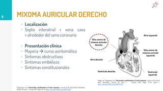 MIXOMA AURICULAR DERECHO
▹ Localización
▹ Septo interatrial > vena cava
> alrededor del seno coronario
▹ Presentación clínica
▹ Mayoría  curso asintomático
▹ Síntomas obstructivos
▹ Síntomas embólicos
▹ Síntomas constitucionales
6
Thyagarajan et al. Extracardiac manifestations of atrial myxomas. Journal of the Saudi Heart Association.
Volume 29. Issue 1. January 2017. Pages 37-43. https://doi.org/10.1016/j.jsha.2016.07.003
Imagen de Thyagarajan et al. Extracardiac manifestations of atrial myxomas. Journal of the Saudi
Heart Association. Volume 29. Issue 1. January 2017. Pages 37-43. Figure 1.
https://doi.org/10.1016/j.jsha.2016.07.003
Sitio común de
mixoma auricular
derecho
Sitio común de
mixoma auricular
izquierdo
Atrio izquierdo
Atrio derecho
Ventrículo
izquierdo
Ventrículo derecho
 