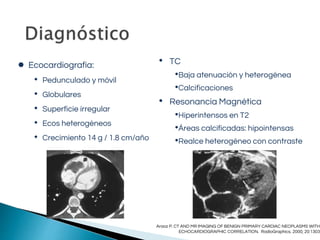 ● Ecocardiografía:
• Pedunculado y móvil
• Globulares
• Superficie irregular
• Ecos heterogéneos
• Crecimiento 14 g / 1.8 cm/año
• TC
•Baja atenuación y heterogénea
•Calcificaciones
• Resonancia Magnética
•Hiperintensos en T2
•Áreas calcificadas: hipointensas
•Realce heterogéneo con contraste
Araoz P. CT AND MR IMAGING OF BENIGN PRIMARY CARDIAC NEOPLASMS WITH
ECHOCARDIOGRAPHIC CORRELATION. RadioGraphics. 2000; 20:1303
 