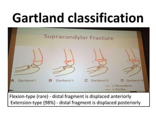 Gartland classification
Flexion-type (rare) - distal fragment is displaced anteriorly
Extension-type (98%) - distal fragment is displaced posteriorly
 