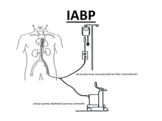 IABP
 