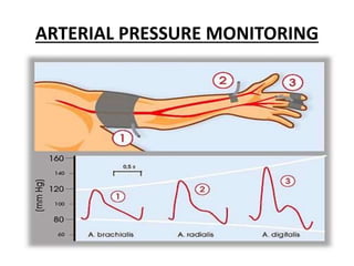 ARTERIAL PRESSURE MONITORING
 