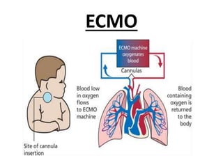 ECMO
 
