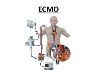 ECMO
 