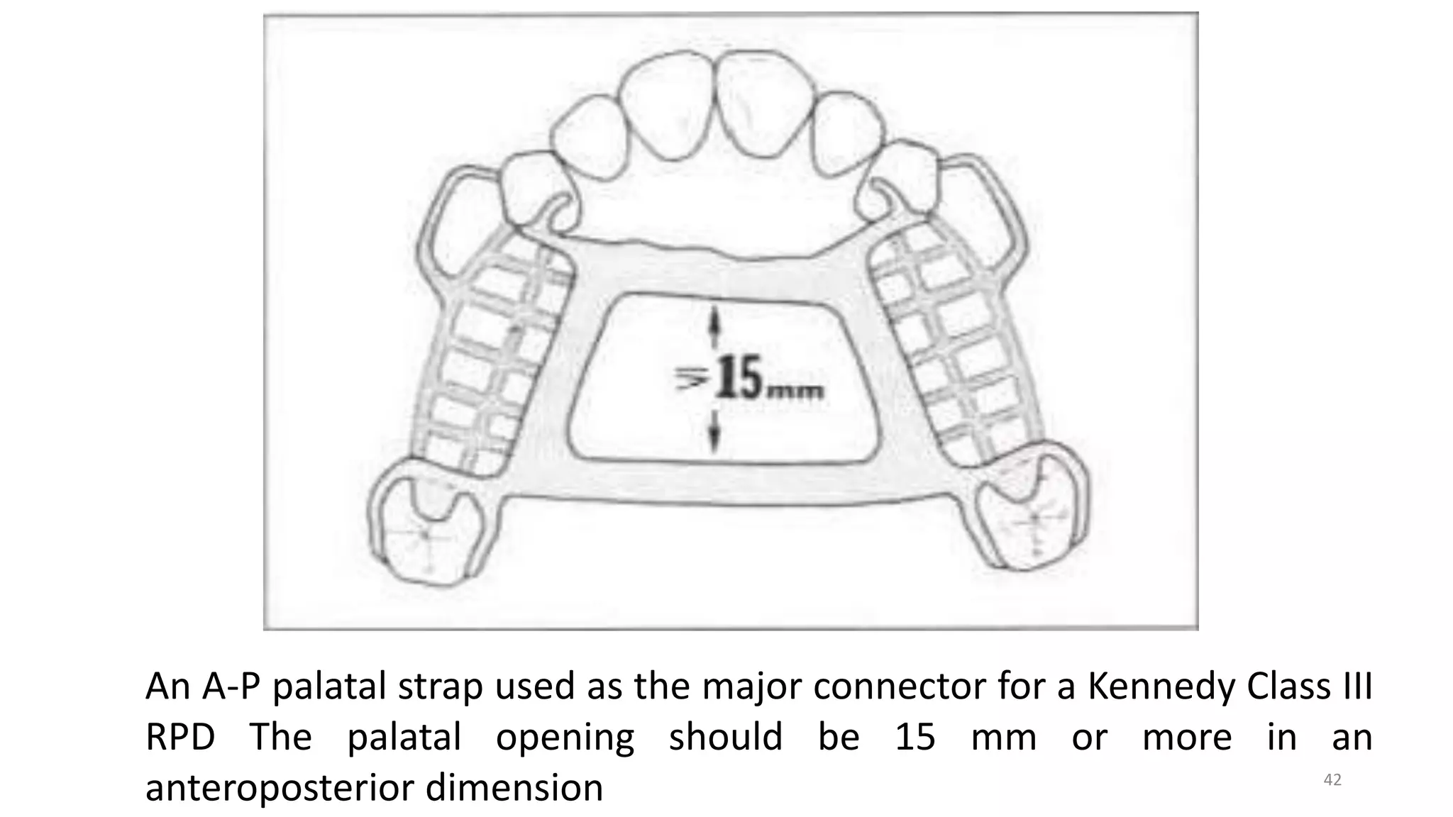 Palatable Strap Rpd Practical Points of View for Removable Partial Denture | PPTX