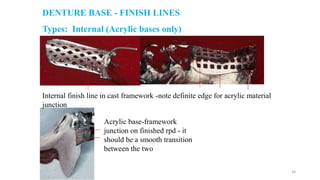 Metal Rpd Finish Line Practical Points of View for Removable Partial Denture | PPTX
