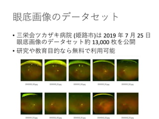 眼底画像のデータセット
• 三栄会ツカザキ病院 (姫路市)は 2019 年 7 月 25 日
眼底画像のデータセット約 13,000 枚を公開
• 研究や教育目的なら無料で利用可能
 