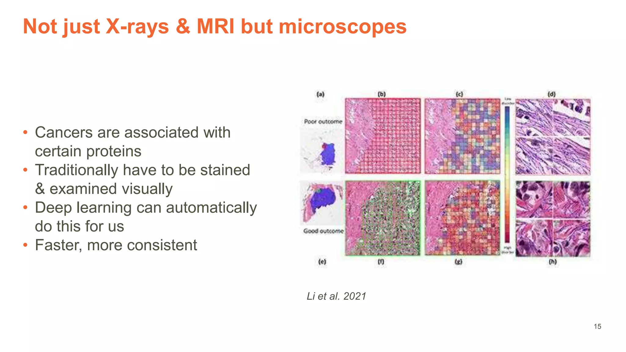 15
Not just X-rays & MRI but microscopes
• Cancers are associated with
certain proteins
• Traditionally have to be stained
& examined visually
• Deep learning can automatically
do this for us
• Faster, more consistent
Li et al. 2021
 