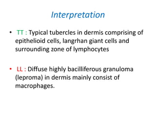 Interpretation
• TT : Typical tubercles in dermis comprising of
epithelioid cells, langrhan giant cells and
surrounding zone of lymphocytes
• LL : Diffuse highly bacilliferous granuloma
(leproma) in dermis mainly consist of
macrophages.
 