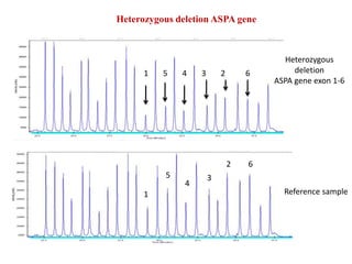 Heterozygous deletion ASPA gene
Heterozygous
deletion
ASPA gene exon 1-6
Reference sample1
1
5
5
4
4
3
3
2
2
6
6
 