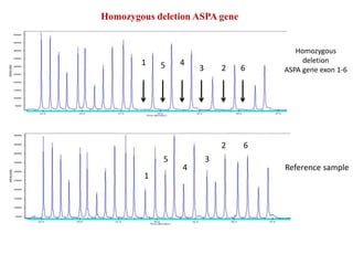 Homozygous deletion ASPA gene
Homozygous
deletion
ASPA gene exon 1-6
Reference sample
1 5 4
3 2 6
1
5
4
3
2 6
 