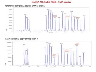 SALSA MLPA kit P060 – SMA carrier
Reference sample: 2 copies SMN1, exon 7
SMA carrier: 1 copy SMN1 exon 7
 