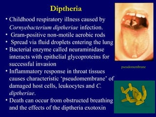 Diptheria
• Childhood respiratory illness caused by
Cornyebacterium diptheriae infection.
• Gram-positive non-motile aerob...