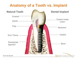 Anatomy of a Tooth vs. Implant Natural Tooth Dental Implant Enamel Dentin Pulp Gum Tissue Periodontal  ligament Custom-made crown Abutment Implant Bone 