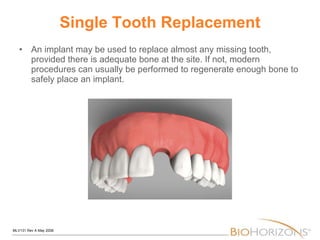 Single Tooth Replacement An implant may be used to replace almost any missing tooth, provided there is adequate bone at the site. If not, modern procedures can usually be performed to regenerate enough bone to safely place an implant. 