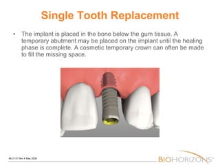Single Tooth Replacement The implant is placed in the bone below the gum tissue. A temporary abutment may be placed on the implant until the healing phase is complete. A cosmetic temporary crown can often be made to fill the missing space. 