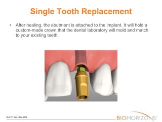 Single Tooth Replacement After healing, the abutment is attached to the implant. It will hold a custom-made crown that the dental laboratory will mold and match to your existing teeth. 