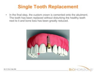 Single Tooth Replacement In the final step, the custom crown is cemented onto the abutment. The tooth has been replaced without disturbing the healthy teeth next to it and bone loss has been greatly reduced.  