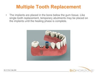 Multiple Tooth Replacement The implants are placed in the bone below the gum tissue. Like single tooth replacement, temporary abutments may be placed on the implants until the healing phase is complete. 