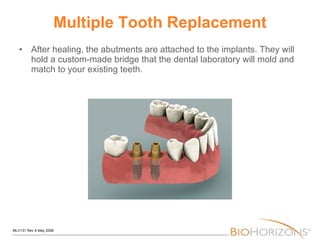 Multiple Tooth Replacement After healing, the abutments are attached to the implants. They will hold a custom-made bridge that the dental laboratory will mold and match to your existing teeth. 