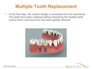Multiple Tooth Replacement In the final step, the custom bridge is cemented onto the abutments. The teeth have been replaced without disturbing the healthy teeth next to them, and bone loss has been greatly reduced.  