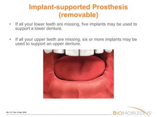 Implant-supported Prosthesis (removable) If all your lower teeth are missing, five implants may be used to support a lower denture.  If all your upper teeth are missing, six or more implants may be used to support an upper denture. 