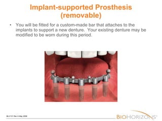 Implant-supported Prosthesis (removable) You will be fitted for a custom-made bar that attaches to the implants to support a new denture.  Your existing denture may be modified to be worn during this period. 