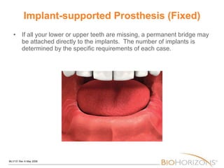 Implant-supported Prosthesis (Fixed) If all your lower or upper teeth are missing, a permanent bridge may be attached directly to the implants.  The number of implants is determined by the specific requirements of each case. 