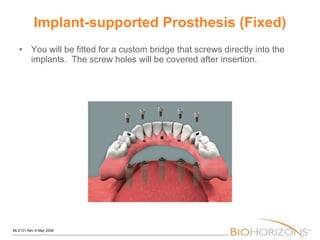 Implant-supported Prosthesis (Fixed) You will be fitted for a custom bridge that screws directly into the implants.  The screw holes will be covered after insertion. 