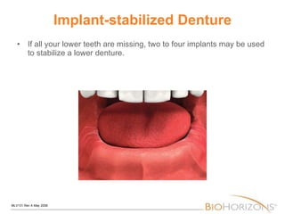Implant-stabilized Denture If all your lower teeth are missing, two to four implants may be used to stabilize a lower denture. 