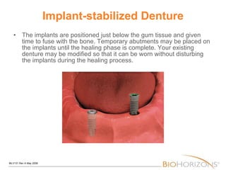 Implant-stabilized Denture The implants are positioned just below the gum tissue and given time to fuse with the bone. Temporary abutments may be placed on the implants until the healing phase is complete. Your existing denture may be modified so that it can be worn without disturbing the implants during the healing process. 