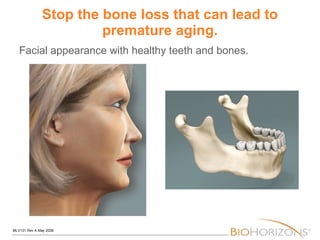 Stop the bone loss that can lead to premature aging. Facial appearance with healthy teeth and bones. 