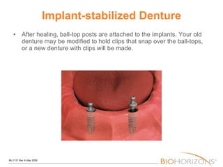 Implant-stabilized Denture After healing, ball-top posts are attached to the implants. Your old denture may be modified to hold clips that snap over the ball-tops, or a new denture with clips will be made. 