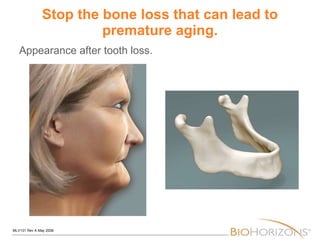 Stop the bone loss that can lead to premature aging. Appearance after tooth loss. 