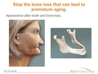 Stop the bone loss that can lead to premature aging. Appearance after tooth and bone loss. 