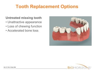 Tooth Replacement Options Untreated missing tooth • Unattractive appearance • Loss of chewing function • Accelerated bone loss 