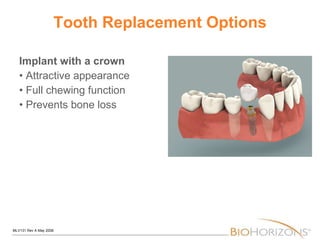 Tooth Replacement Options Implant with a crown • Attractive appearance • Full chewing function • Prevents bone loss 